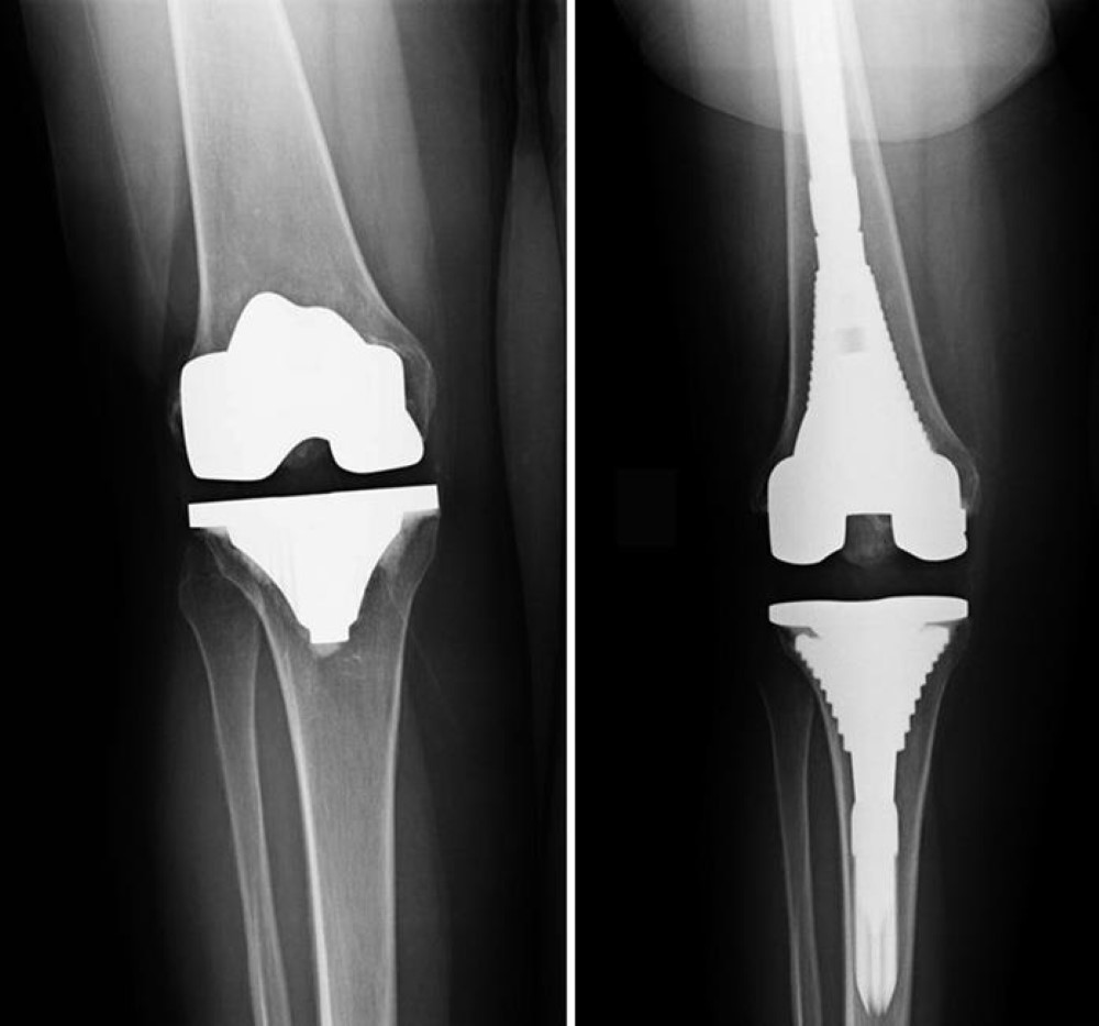 Revision Knee Replacement